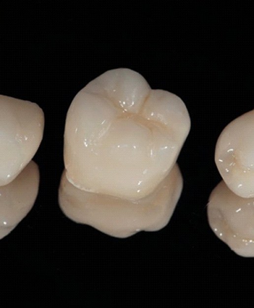 Dental crowns