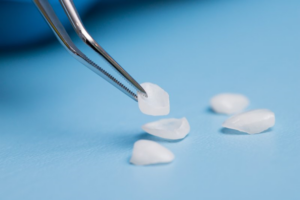 Five dental veneers on a blue background and tweezers lifting one of them up